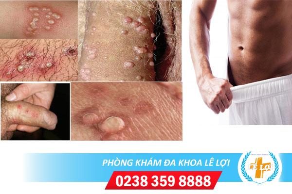 Cách chữa mụn cóc ở dương vật hiệu quả