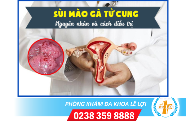 Cách điều trị bệnh sùi mào gà ở cổ tử cung