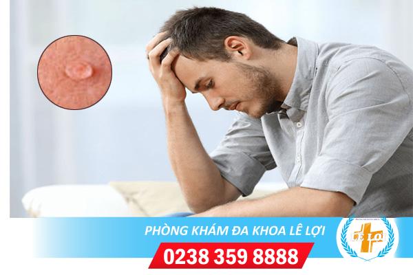 Sùi mào gà ở niệu đạo dấu hiệu và cách điều trị