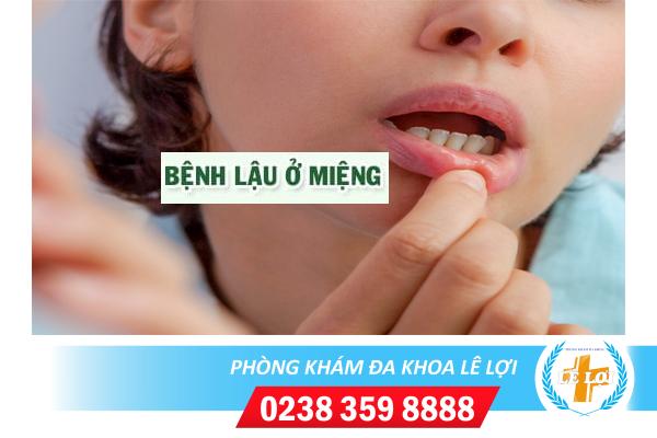 Dấu hiệu nhận biết bệnh lậu ở miệng