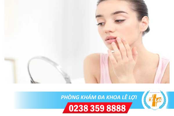 Mụn rộp sinh dục ở miệng dấu hiệu và cách điều trị