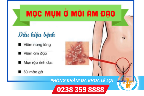 Mọc mụn âm đạo là bị bệnh gì?