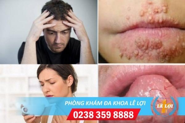 Cách chữa bệnh sùi mào gà miệng