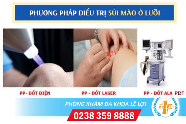 Chữa bệnh sùi mào gà lưỡi thế nào?