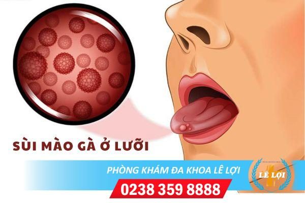 Dấu hiệu của sùi mào gà ở lưỡi