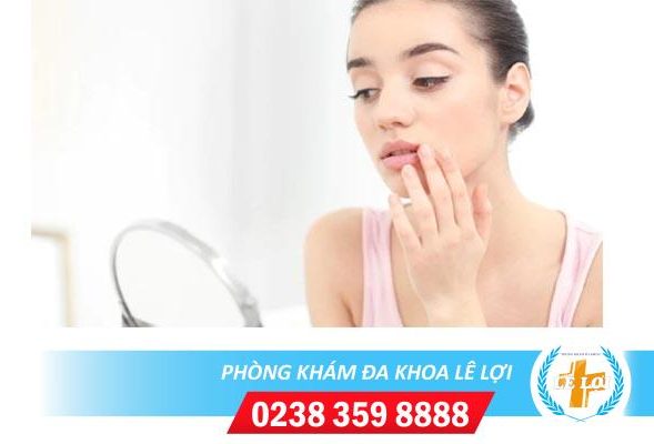 Mọc mụn sinh dục miệng là bệnh gì nguy hiểm không?