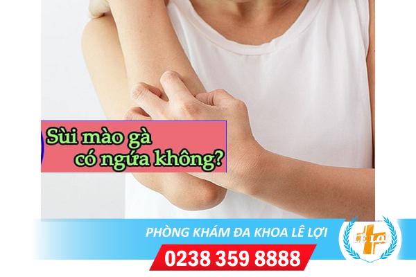 Sùi mào gà có gây ngứa không?