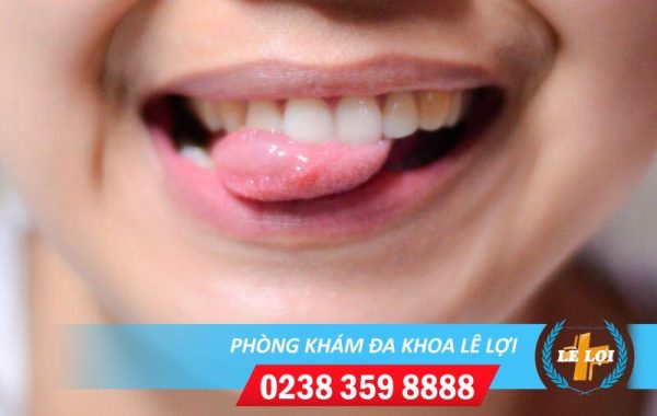 Ảnh bệnh sùi mào gà ở miệng