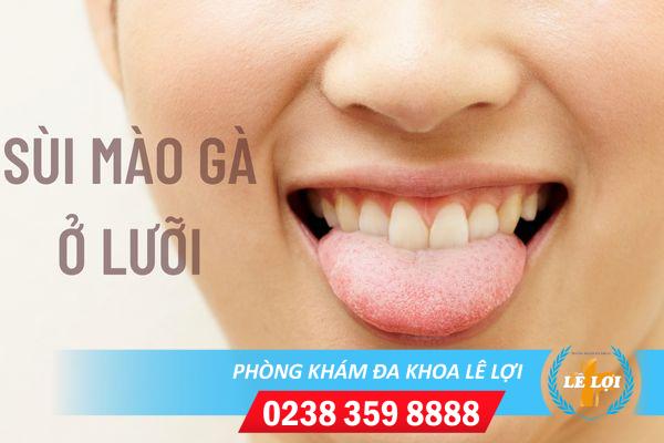 Sùi mào gà ở lưỡi có đau không?