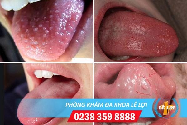 Khám sùi mào gà ở lưỡi nên đến đâu?