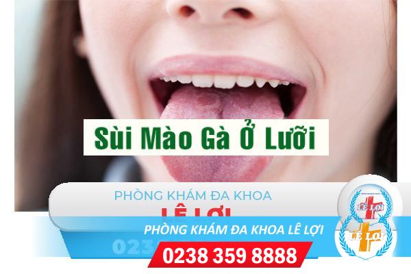 Triệu chứng bệnh sùi mào gà ở lưỡi