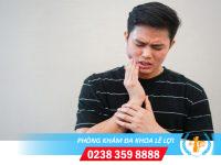 Địa chỉ khám sùi mào gà ở miệng hiệu quả uy tín