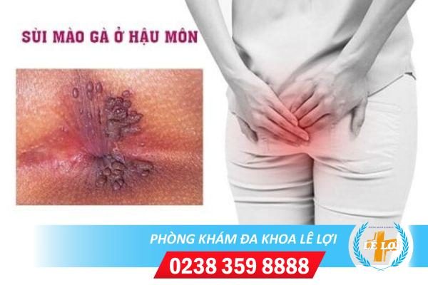 Biểu hiện sùi mào gà ở hậu môn thường gặp