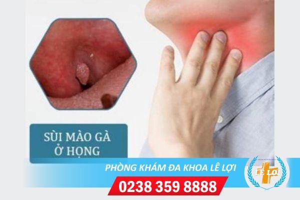 Biểu hiện sùi mào gà ở họng ai cũng nên biết