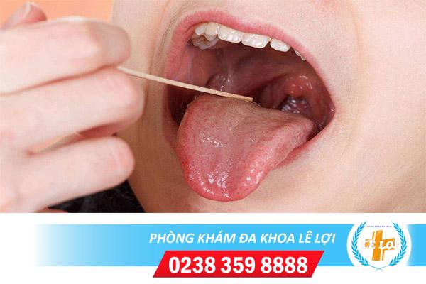 Mụn thịt ở cuống lưỡi nguyên nhân và cách điều trị