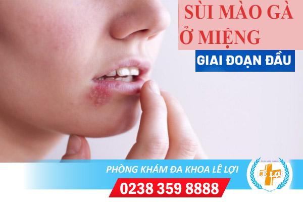 Sùi mào gà ở miệng giai đoạn đầu dấu hiệu và cách chữa