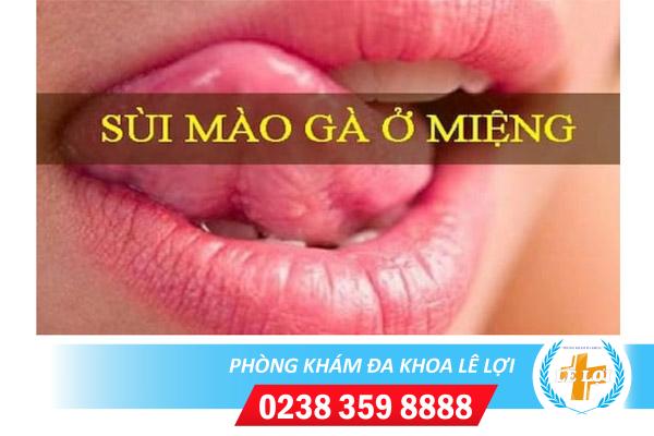 Phòng khám chữa sùi mào gà ở miệng hiệu quả