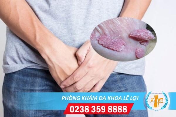 Các giai đoạn sùi mào gà ở nam giới