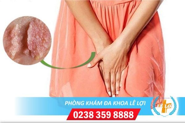 Sùi mào gà ở nữ giai đoạn cuối dấu hiệu và cách điều trị