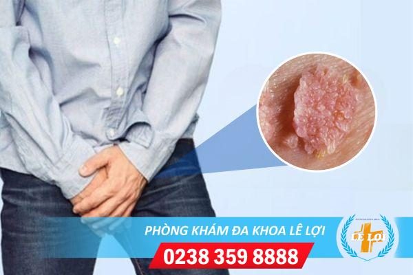 Cu bị sùi mào gà biểu hiện thế nào?