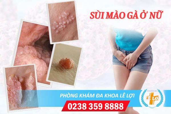 Các giai đoạn sùi mào gà ở nữ và cách điều trị