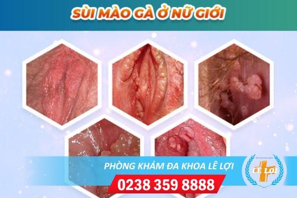 Địa chỉ chữa sùi mào gà ở âm đạo uy tín tại Vinh