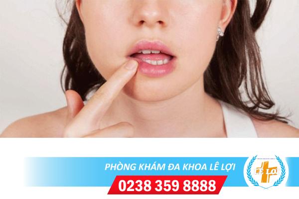 Bệnh herpes ở miệng dấu hiệu và cách điều trị