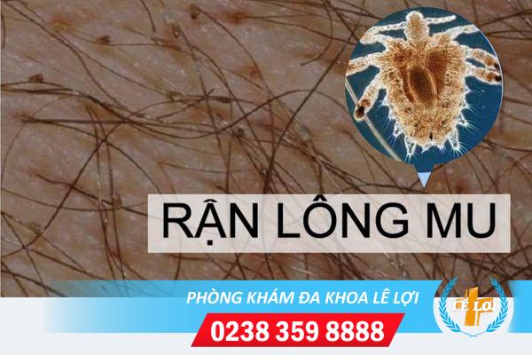 Chữa rận lông mu thế nào hiệu quả?