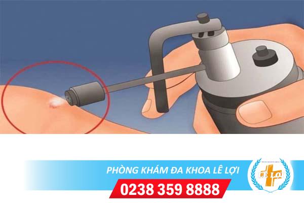 Đốt mụn rộp sinh dục thế nào hiệu quả không?