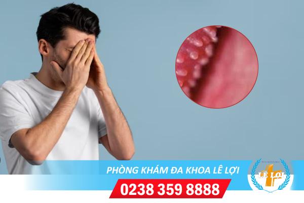 Chuỗi hạt ngọc ở dương vật là bệnh gì?