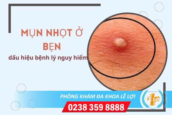 Nổi mụn nhọt ở bẹn là bệnh gì?