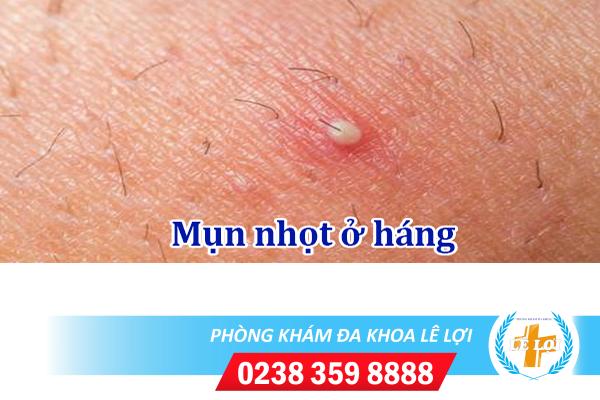 Mụn nhọt ở háng phải làm sao?