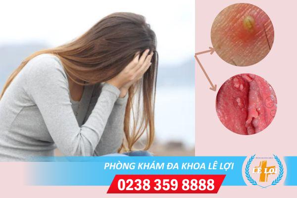 Mụn thịt sinh dục nữ là bị bệnh gì?