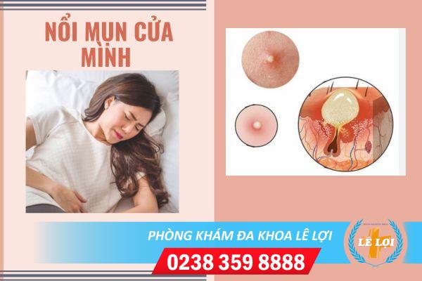 Nổi mụn cửa mình phải làm sao?