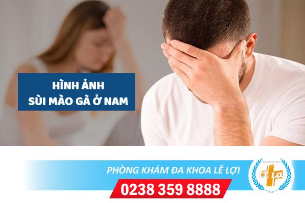 Hình ảnh sùi mào gà ở nam dấu hiệu và cách điều trị