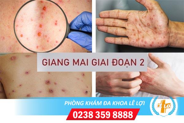 Bệnh giang mai giai đoạn 2 dấu hiệu và cách điều trị