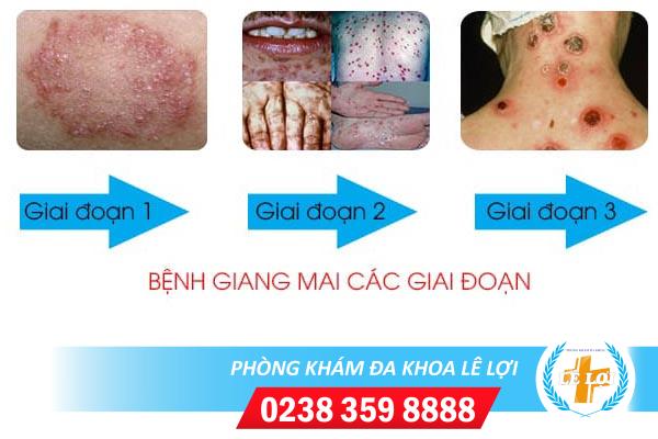 Bệnh giang mai giai đoạn 3 có biểu hiện gì?