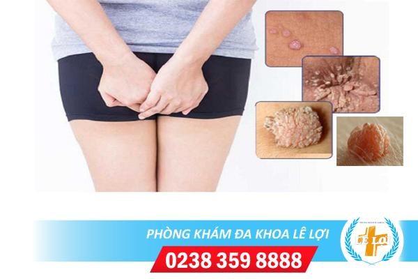 Mụn cóc hậu môn do đâu điều trị thế nào?