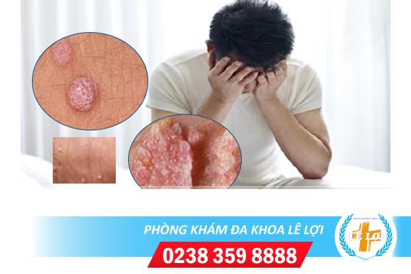 Phương pháp ala pdt là gì? chữa trị hiệu quả không?