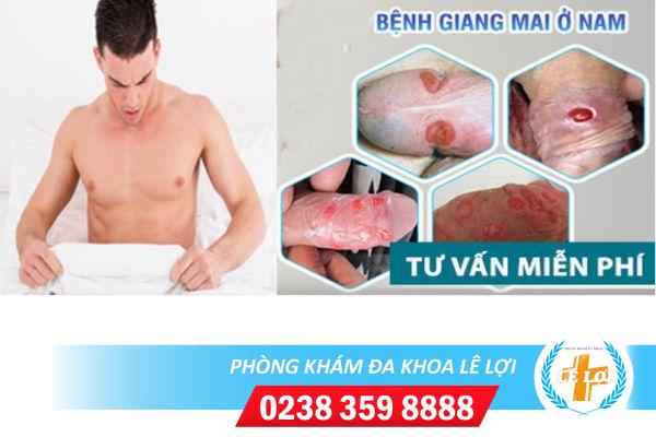 Dấu hiệu bệnh giang mai dương vật và cách điều trị