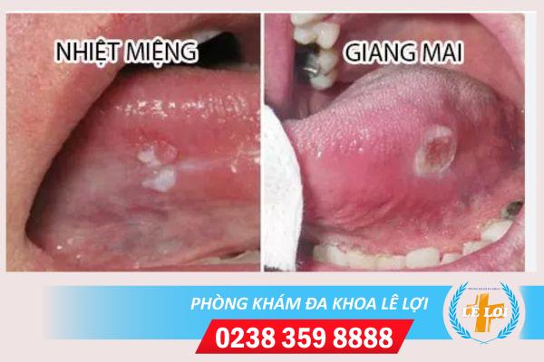 Dấu hiệu bệnh giang mai lưỡi và cách điều trị