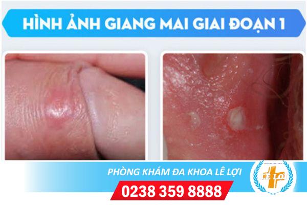 Dấu hiệu của bệnh giang mai giai đoạn đầu