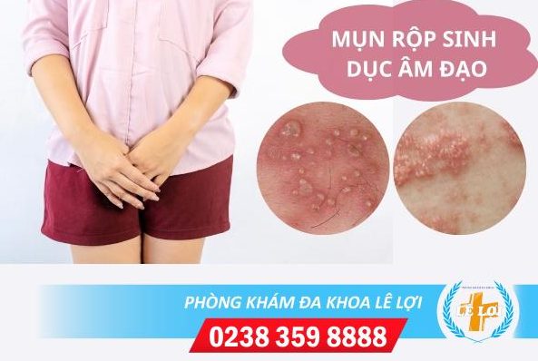 Nguyên nhân mụn rộp sinh dục ở âm đạo