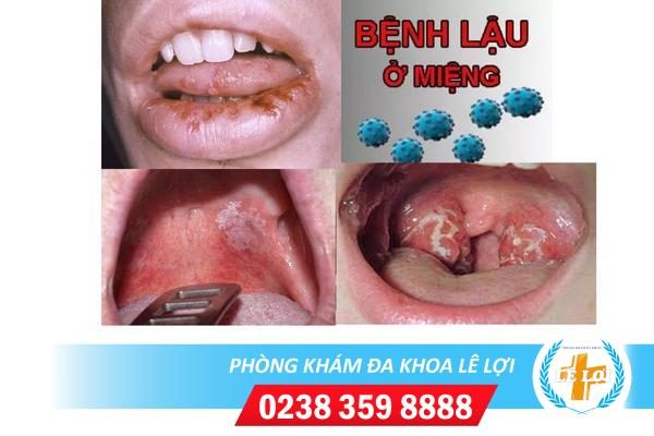 Biểu hiện lậu ở miệng và cách điều trị