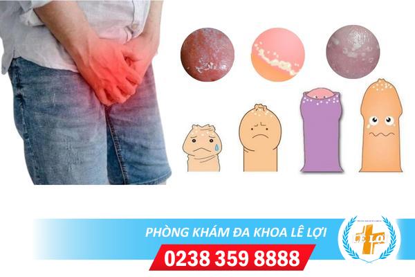 Đốm trắng quy đầu là bị bệnh gì nguy hiểm không?