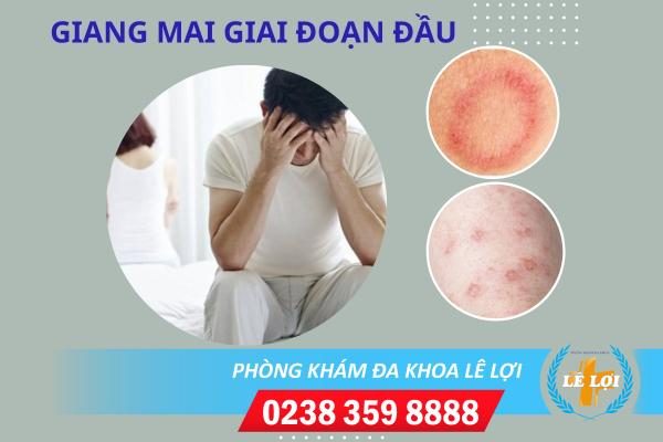 Cách nhận biết giang mai giai đoạn đầu