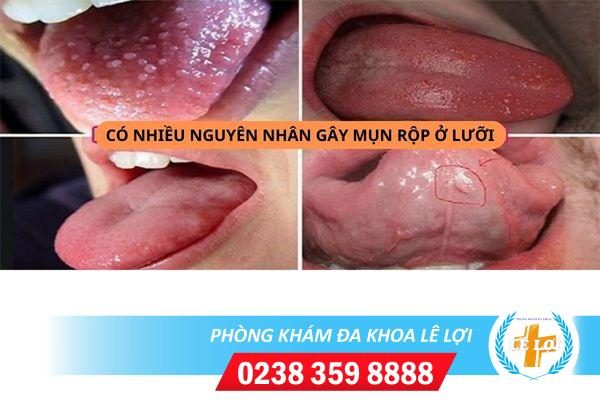 Cách điều trị mụn rộp ở lưỡi hiệu quả