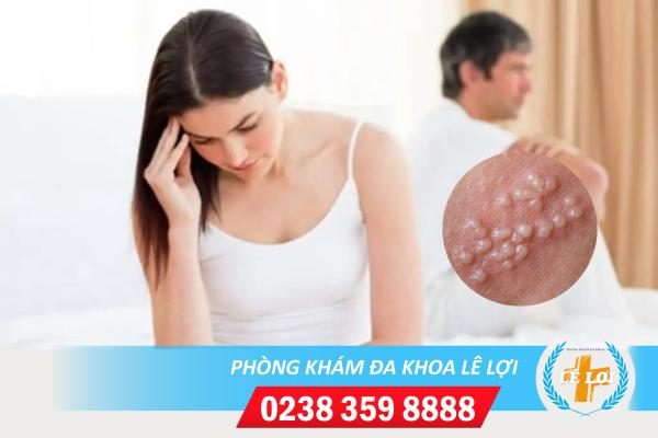 Hình ảnh mụn rộp sinh dục và cách điều trị