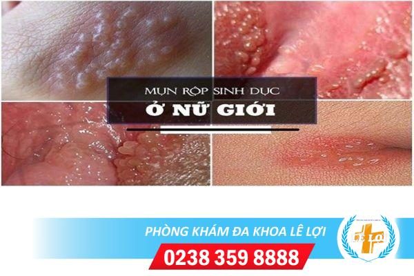 Biểu hiện bệnh mụn rộp sinh dục ở nữ và cách chữa trị