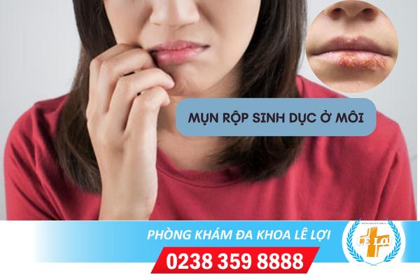 Mụn rộp sinh dục ở môi những điều bạn cần biết